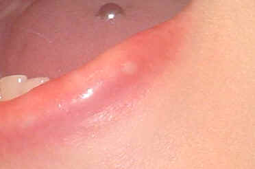 lip lump perlane some stretched when